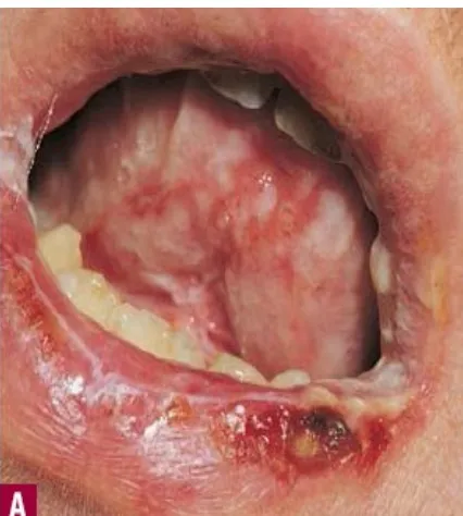 Gambar 9.4 A. erosi dan nekrosis ekstensif bibir bawah dan mukosa mulut