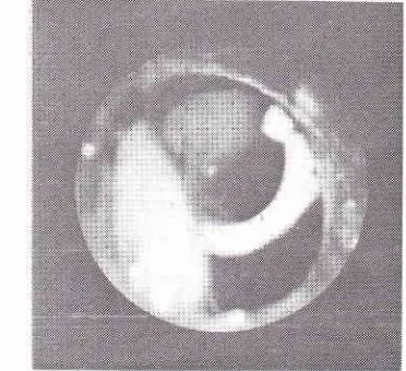 Figure 7. part Insertion ofT+ube through the resectedofthe trachea.