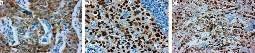 Figure 1. Immunohistochemistry A) CK-5 brown color in the membrane and cytoplasm; B) Mutant p53 protein, it shows positivity as brown color in the nuclei; C) Topoisomerase IIα, the positivity is represented by brown color in the nuclei