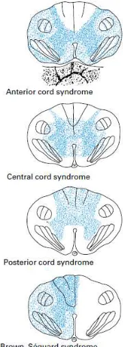 Gambar 3.  Potongan melintang dari korda spinalis, menunjukkan sindroma cedera medula spinalis parsial 