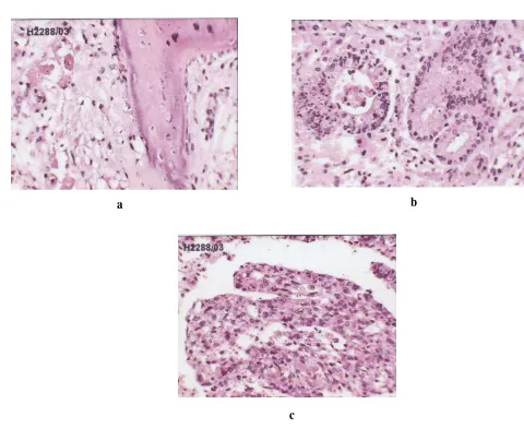 Figure 1. Microphotograph showing  ( H&E,  X40) a) undifferentiated mesenchymal tissue and bony trabeculae, b) glandular differentiation, c) glomeruloid body 