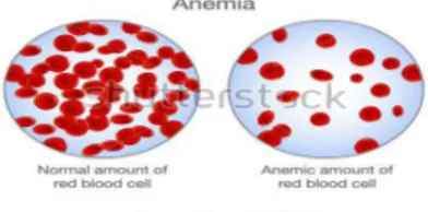 Gambar 2.7 Darah Normal dan Penyakit Anemia 35 b.  Leukemia 