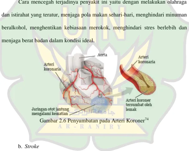 Gambar 2.6 Penyumbatan pada Arteri Koroner 74