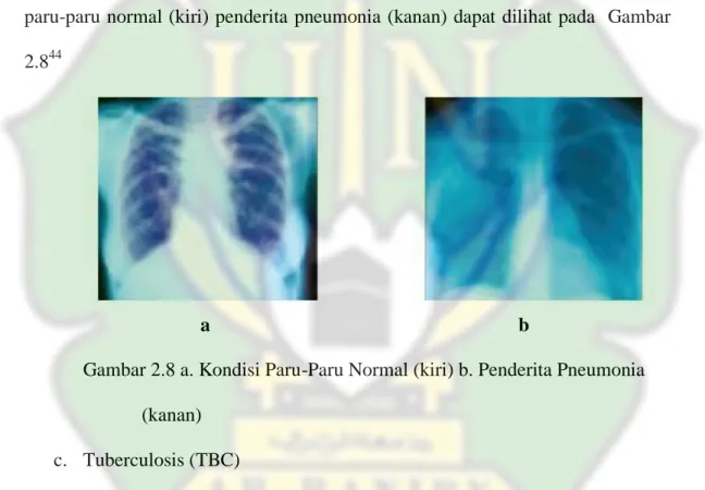 Gambar 2.8 a. Kondisi Paru-Paru Normal (kiri) b. Penderita Pneumonia   (kanan) 