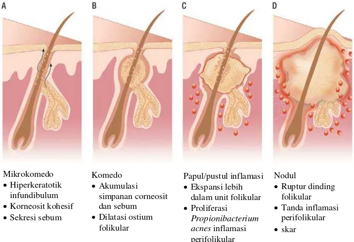 Gambar 2.2. Patogenensis Acne vulgaris 
