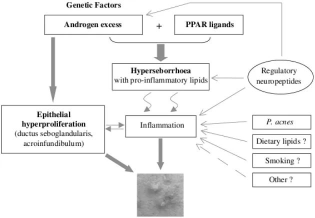 Gambar 2.3. Aspek Moderen Patogenesis Acne 