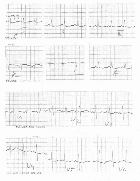 Figure 1. The electrocardiogram showed sinus rhythm, right axis deviation, and leil atrial enlargement.