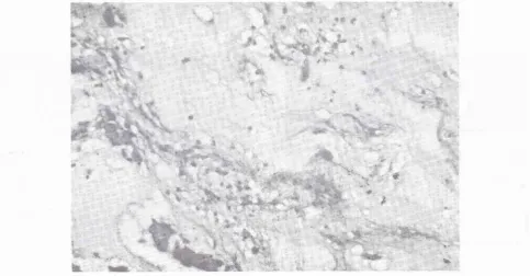 Figure 4. Gross ( risht specimen of the large tumor excised from the left atrium ( Ieft ), and during the tumor renloval )