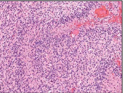 Gambar 2.7. Gambaran histopatologi dari astrositoma pilositik (WHO grade I) Sumber: Brain Tumor Research, 2008