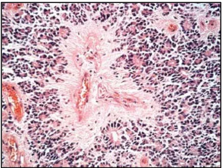Gambar 2.10. Gambaran histopatologi dari oligodendroglioma (Sumber: Kumar, V., Abbas, A.K., Aster, J.C., 2013