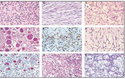 Gambar 2.11. Gambaran histopatologi berbagai varian meningioma WHO grade I:  dengan antibodi anti-CD34; G: meningioma meningotelial (A), fibroblastik (B), transisional (C), psammomatosa (D), angiomatosa (E), mikrokistik (F), sekretori (G), limfoplasmasit (
