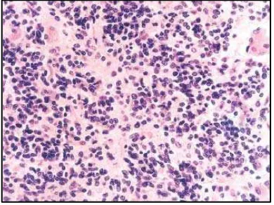 Gambar 2.12. Gambaran histopatologi berbagai varian meningioma WHO grade II: meningioma atipikal (A), neurochirurgie/IMG/pdf/LancetNe.pdfhematoksilin-eosin