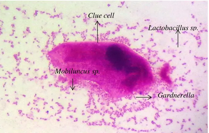 Gambar  2.  Hasil mikroskopis sampel sekret vagina dengan pewarnaan Gram dari 
