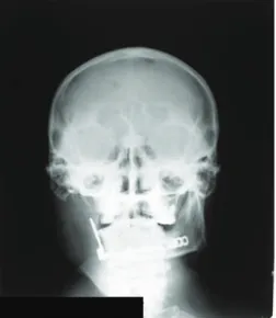 Figure 1. Skull x-ray showing mandibular plate placed after hemimandibulectomy