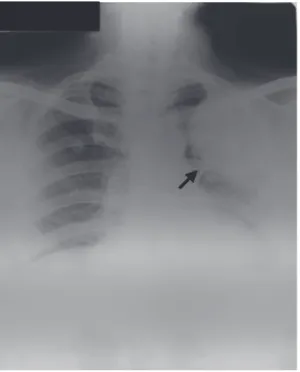 Figure 4aFigure 2. Chest x-ray showing a secondary mass in the left upper Figure 4b