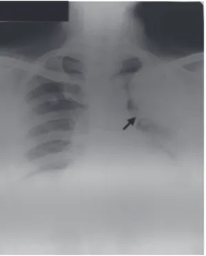 Figure 4aFigure 2. Chest x-ray showing a secondary mass in the left upper Figure 4b