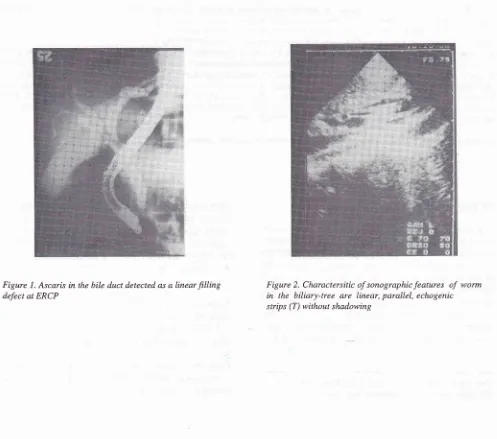 Figure 2. Charactersitic of sonographicfeatures ofin are parallel, 