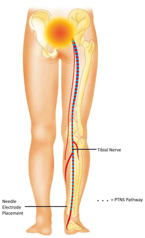 Figure 3. PTNS pathway to sacral plexus