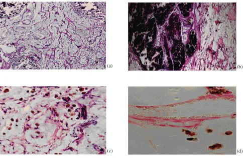 Figure 1. Histopathologic examination of the scrotal mass. (a) Myxoid stroma contained a hypocellular lesion with delicate 