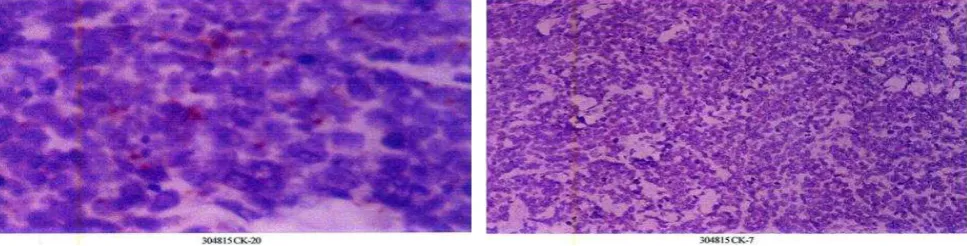 Figure 3. Immunohistochemical staining showing CK20 positive and CK7 negative 