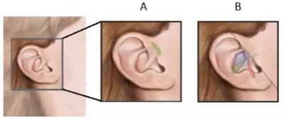 Gambar 1. Variasi lokasi sinus preaurikular (A)Variant Classic, (B) Post-curicular Variant 12