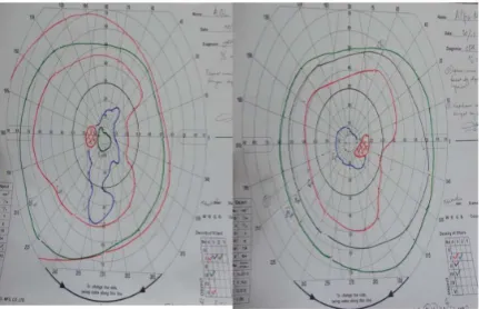Gambar 6. Optical Coherence Tomography (OCT)A. Analisis Retinal Nerve ﬁber layer (RNFL), B