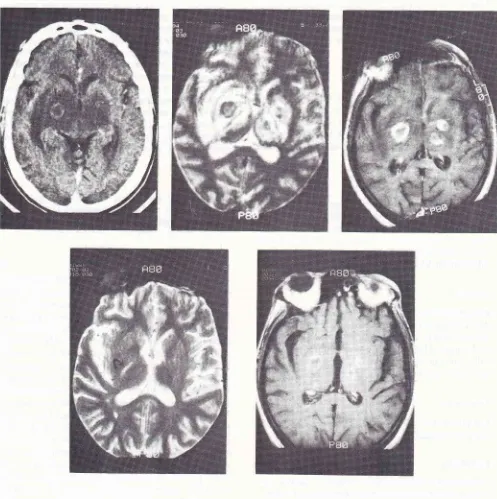 Figure l.Contrast-augnented CT h)'perintensity (curved (b,c). (a) shows bilateral thalatnic and basal ganglia swelling