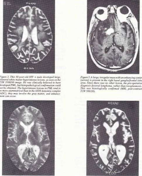 Figure 2. This 30-year-old HN + male developed large,bilateral white matter hyperintense 