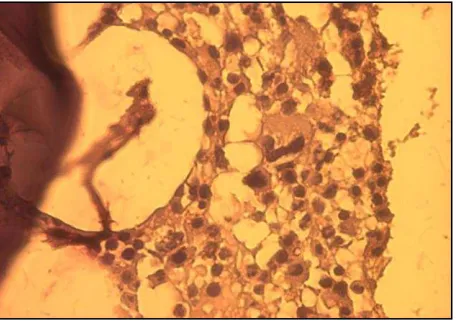 Figure 3. Bone biopsy stained with HE shows plasma cell myelomas 