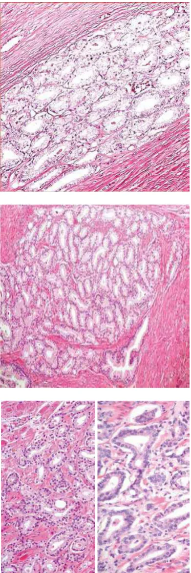 Gambar 4 Adenocarcinoma Prostat-