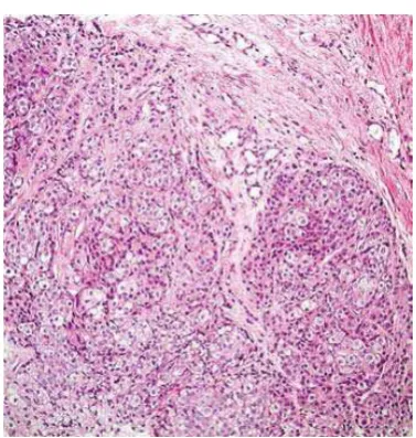 Gambar 7 Adenocarcinoma Prostat-