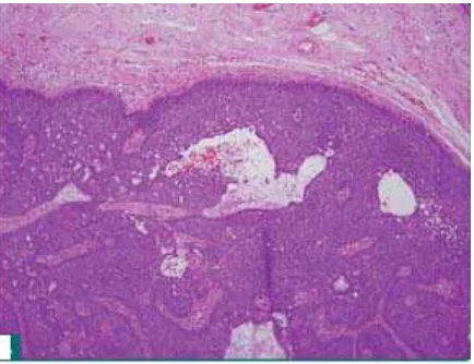 Gambar 2.9 : Karsinoma sel basal nodular 
