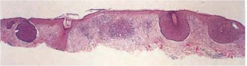 Gambar 2.12:  Adanya massa irreguler pada sel basofilik yang luas mulai dari epidermis sampai ke dermis