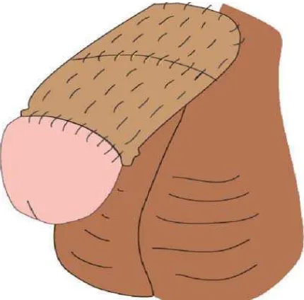 Figure 1. One-sheet full thickness skin graft is applied spirally and also securely attached to the denuded penile body by continuous running suture covering the graft here and there, and not only the graft edges.