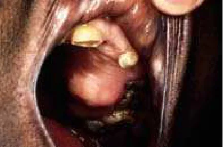 Gambar 4.  Osteoma di rahang atas15