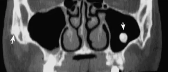 Gambar 5.  Gambaran coronal CT dari maksila  yang menunjukkan                      zigomatik sebelah kanan (arrow)                     osteoma pada sinus maksila sebelah kiri dan  pada tulang 6 