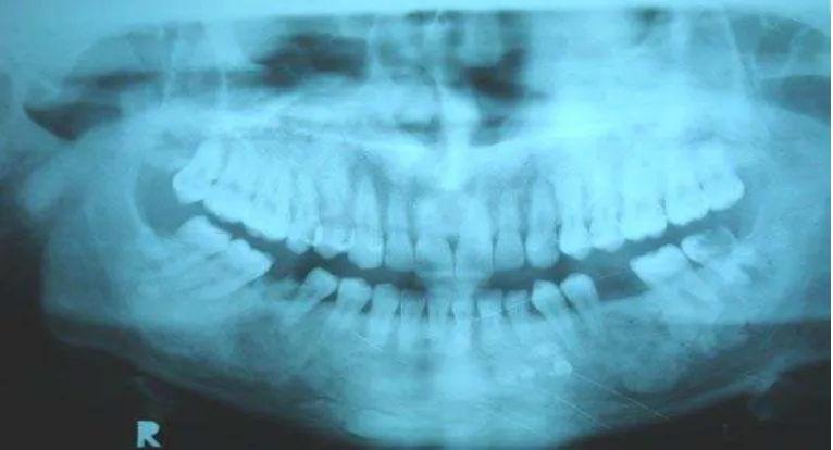 Gambar 10. Foto panoramik menunjukkan adanya multiple osteoma dan gigi kaninus              yang impacted  pada mandibula1 