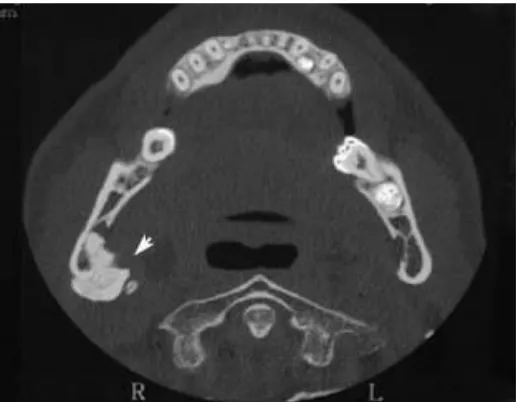 Gambar 12.  Gambar axial CT  menunjukkan beberapa daerah                       kelebihan gigi pada mandibula serta adanya      