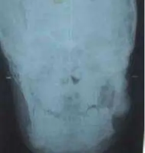 Gambar 18.                       sedikit (arrowhead)                       disepanjang mandibula, sedangkan  pada maksila hanya     Gambar menunjukkan adanya multiple osteoma (arrow)  15 