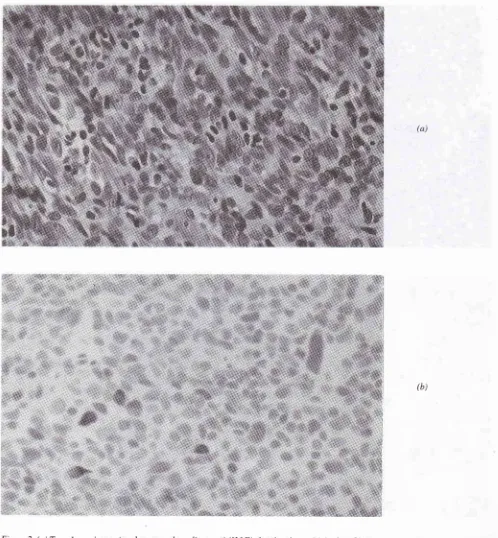 Figure 2. (a) Type A carcinoma (moderate grade malignancy) (H&E) showing 4+ positivity for p53 iimunostaining(b) The pleomorphic tumor cells display prominent nucleoli and spindledforms