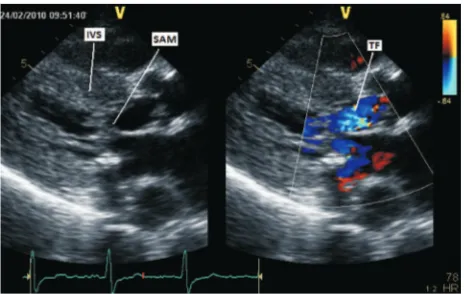 Figure 1. Long axis view of echocardiography demonstrates IVS hypertrophy and systolic anterior motion (SAM)