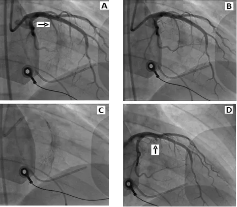 Figure 3. (A) Angiography of left coronary artery demonstrates septal perforator artery (arrow)