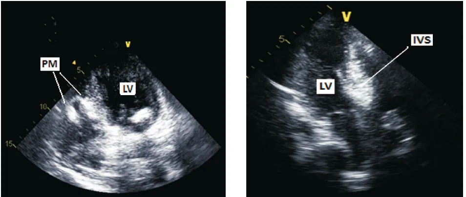 Figure 4. Myocardial contrast echocardiography by Levovist™ injection into septal perforator artery