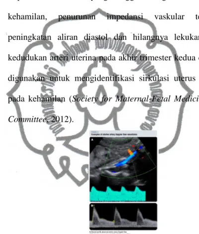 Gambar  2.4  Doppler  Arteri  Uterina  (Society  for  Maternal-Fetal  Medicine Publications Committee, 2012)