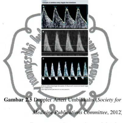 Gambar 2.5 Doppler Arteri Umbilikalis (Society for Maternal-Fetal  Medicine Publications Committee, 2012)