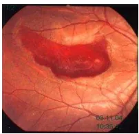 Figure 1 a. pre-injection with visual acuity of 6 m CF. b. one day post injection, the hemorrhage is displaced inferiorly and visual acuity becomes 6/15