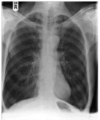 Gambar 2.3.  Gambaran radiologi penderita PPOK.28 