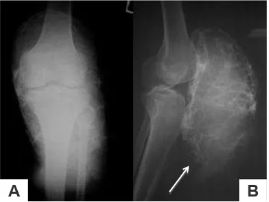 Figure 1. Ulcerated tumor at left knee, anteroposterior (A) and lateral (B) view. Big tumor at the patellar bone accompanied with necrotic tissue in large ulcer at lower part of the tumor, no swelling or edema in distal part of the extremity (compared with contralateral side)