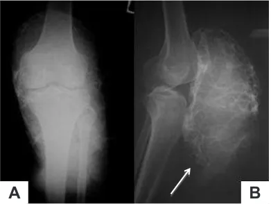 Figure 1. Ulcerated tumor at left knee, anteroposterior (A) and lateral (B) view. Big tumor at the patellar bone accompanied with necrotic tissue in large ulcer at lower part of the tumor, no swelling or edema in distal part of the extremity (compared with contralateral side)