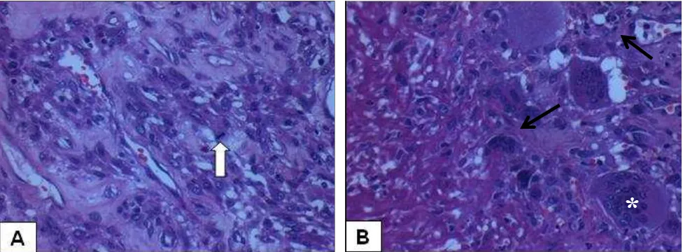 Figure 3. Photomicrographs of the primary malignant GCT. (A) Low magniication image showed mitosis, atypic, pleomorphic, and bi-zarre cells (white arrow)